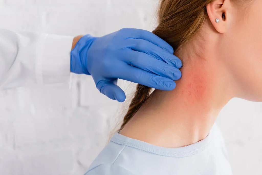 Healthcare professional wearing blue gloves examining a red, inflamed dermatitis patch on the back of a woman’s neck. dermatitis treatment in Huddersfield.